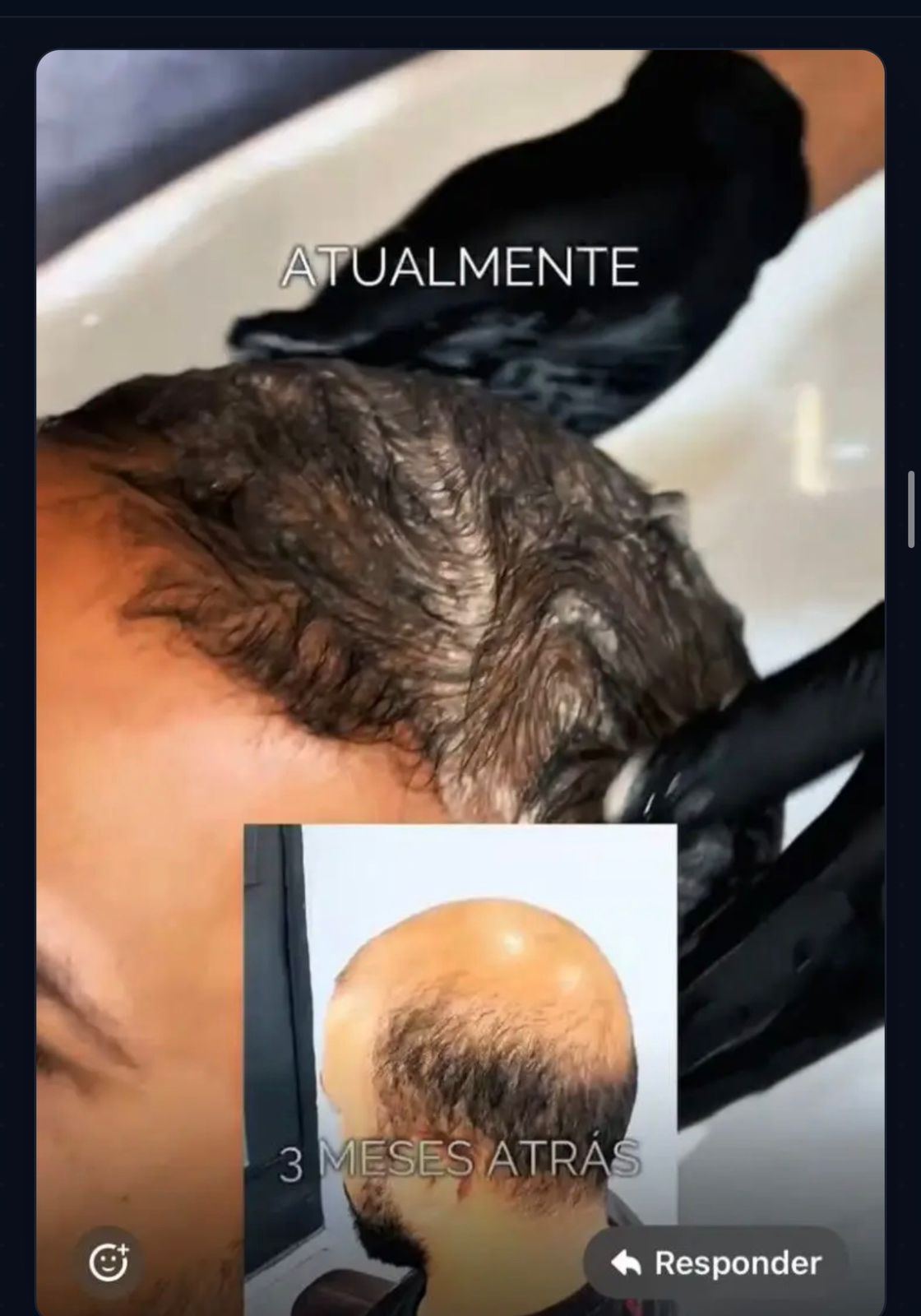 Antes e depois, 3 meses
